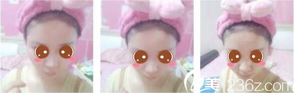 韓國(guó)延世毛百麗植發(fā)中心楊泫準(zhǔn)毛發(fā)移植真人案例術(shù)后第七天 韓國(guó)延世毛百麗植發(fā)中心楊泫準(zhǔn)毛發(fā)移植真人案例術(shù)后第七天