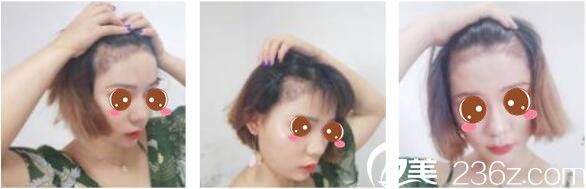 韓國(guó)延世毛百麗植發(fā)中心楊泫準(zhǔn)毛發(fā)移植真人案例術(shù)后二十一天 韓國(guó)延世毛百麗植發(fā)中心楊泫準(zhǔn)毛發(fā)移植真人案例術(shù)后二十一天