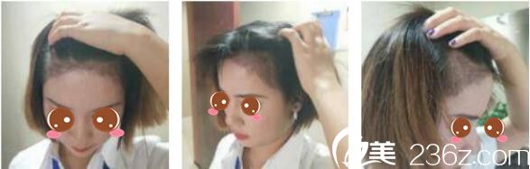 韓國(guó)延世毛百麗植發(fā)中心楊泫準(zhǔn)毛發(fā)移植真人案例術(shù)后一個(gè)月 韓國(guó)延世毛百麗植發(fā)中心楊泫準(zhǔn)毛發(fā)移植真人案例術(shù)后一個(gè)月