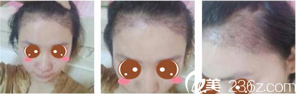 揭秘韓國(guó)延世毛百麗植發(fā)技術(shù)，看楊泫準(zhǔn)為我做的發(fā)際線種植術(shù)后效果圖