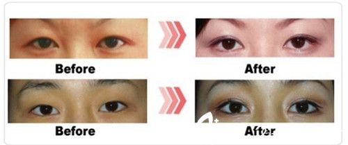 李武永院長(zhǎng)雙眼皮手術(shù)案例分享 李武永院長(zhǎng)雙眼皮手術(shù)案例分享