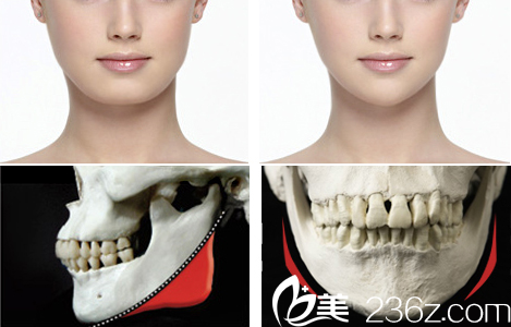 面部輪廓手術(shù)前后對(duì)比 面部輪廓手術(shù)前后對(duì)比