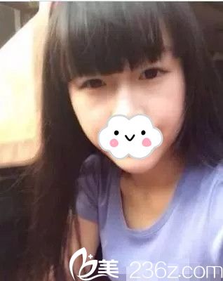 雙眼皮手術(shù)前照片 雙眼皮手術(shù)前照片