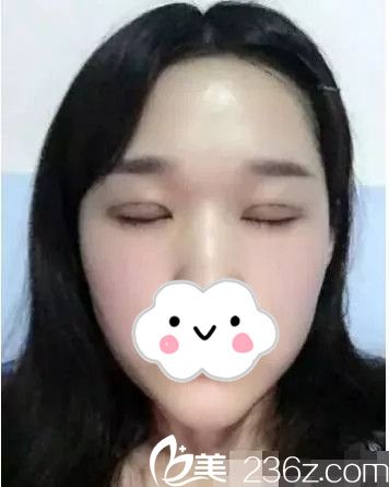 雙眼皮拆線了 雙眼皮拆線了