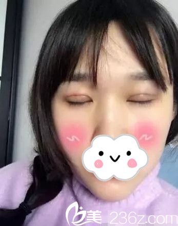 李武永雙眼皮手術(shù)案例分享 李武永雙眼皮手術(shù)案例分享