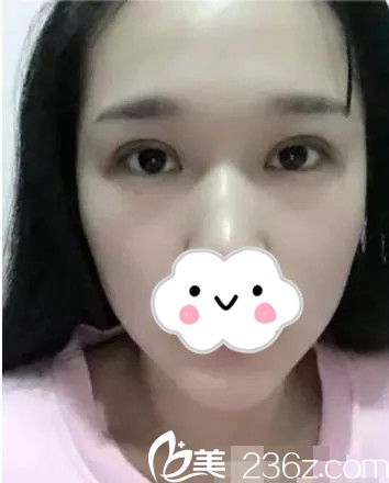 雙眼皮術(shù)后15天效果 雙眼皮術(shù)后15天效果