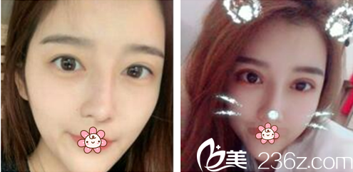 金均泰院長雙眼皮修復(fù)案例 金均泰院長雙眼皮修復(fù)案例