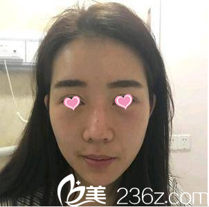 在北京美萊做面部脂肪填充前樣子 在北京美萊做面部脂肪填充前樣子