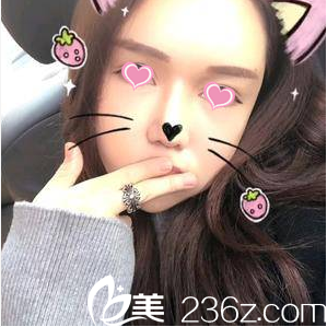 北京美來面部脂肪填充案例第32天效果 北京美來面部脂肪填充案例第32天效果