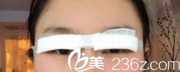 全切雙眼皮術(shù)后當(dāng)天
