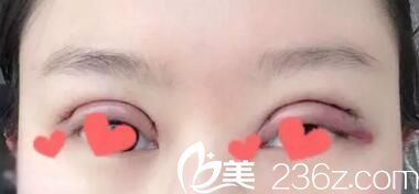 在名流割雙眼皮術(shù)后第二天