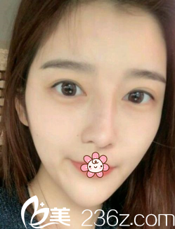 之前做的那個(gè)雙眼皮 之前做的那個(gè)雙眼皮