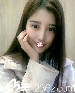 金均泰雙眼皮修復(fù)術(shù)后一周 金均泰雙眼皮修復(fù)術(shù)后一周