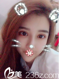 韓國(guó)NYPS整形外科雙眼皮修復(fù)術(shù)后23天 韓國(guó)NYPS整形外科雙眼皮修復(fù)術(shù)后23天