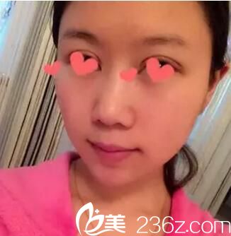 割雙眼皮術(shù)后第五天拆線