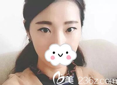 雙眼皮手術(shù)前 雙眼皮手術(shù)前