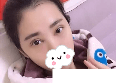 雙眼皮手術(shù)后2天 雙眼皮手術(shù)后2天