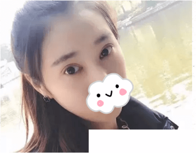 雙眼皮術(shù)后5天恢復(fù)情況 雙眼皮術(shù)后5天恢復(fù)情況