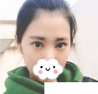 魏成潤(rùn)院長(zhǎng)雙眼皮手術(shù)案例效果 魏成潤(rùn)院長(zhǎng)雙眼皮手術(shù)案例效果