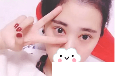 韓國(guó)伍人整形醫(yī)院雙眼皮案例 韓國(guó)伍人整形醫(yī)院雙眼皮案例