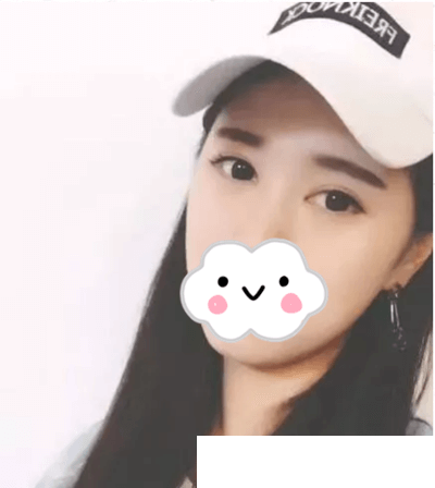 趁著去韓國旅游找伍人整形醫(yī)院魏成潤做了雙眼皮，真的很值