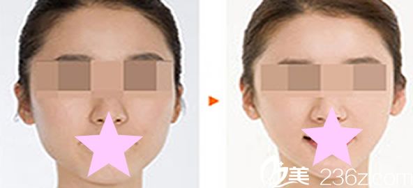 鄭州醫(yī)德佳整形美容胡斌院長微創(chuàng)玻尿酸瘦臉案例