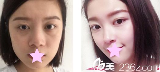 蘭州亞韓整形鼻綜合隆鼻+去眼袋前后效果對(duì)比 蘭州亞韓整形鼻綜合隆鼻+去眼袋前后效果對(duì)比