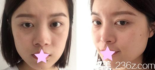 蘭州亞韓整形醫(yī)院隆鼻前 蘭州亞韓整形醫(yī)院隆鼻前