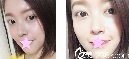 綜合隆鼻一個(gè)月后的恢復(fù)效果 綜合隆鼻一個(gè)月后的恢復(fù)效果