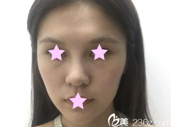 蘭州亞韓整形醫(yī)院自體脂肪填充全臉前 蘭州亞韓整形醫(yī)院自體脂肪填充全臉前