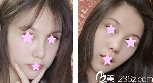 ?臉頰凹陷怎么辦 蘭州亞韓整形雷蓓醫(yī)生給我做全臉脂肪填充的效果案例供大家參考