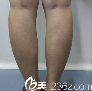 在北京美萊做共振吸脂前樣子 在北京美萊做共振吸脂前樣子