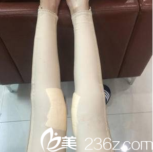 北京美萊共振吸脂第8天效果 北京美萊共振吸脂第8天效果