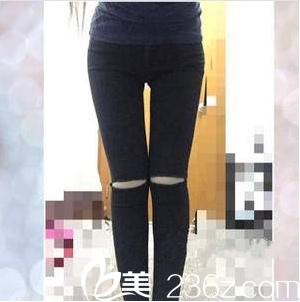 北京美萊黃杰共振吸脂案例第35天效果 北京美萊黃杰共振吸脂案例第35天效果