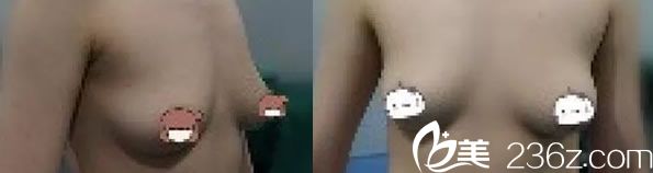 崔平林醫(yī)生自體脂肪隆胸案例前 崔平林醫(yī)生自體脂肪隆胸案例前