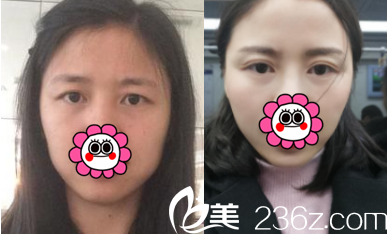 北京美萊<!--<i data=20240703-sp></i>-->切開雙眼皮案例 北京美萊<!--<i data=20240703-sp></i>-->切開雙眼皮案例