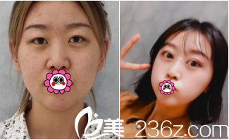 北京美萊<!--<i data=20240703-sp></i>-->眼修復(fù)隆鼻案例 北京美萊<!--<i data=20240703-sp></i>-->眼修復(fù)隆鼻案例