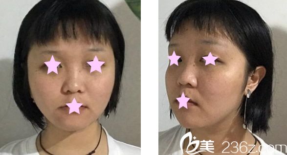 亞韓整形激光祛斑前 亞韓整形激光祛斑前