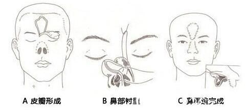 韓國尹熙根整形外科尹熙根鼻再造術(shù) 韓國尹熙根整形外科尹熙根鼻再造術(shù)