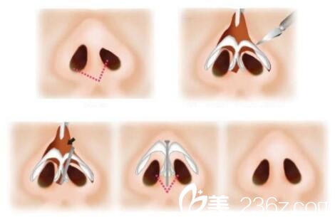 韓國尹熙根整形外科尹熙根鼻再造 韓國尹熙根整形外科尹熙根鼻再造