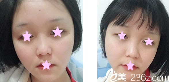 雖然蘭州亞韓整形雷蓓醫(yī)生給我做激光祛斑才10天 但效果好明顯哦