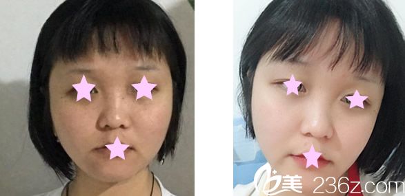 蘭州亞韓激光祛斑前后效果對比 蘭州亞韓激光祛斑前后效果對比