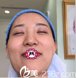 在北京美萊做埋線雙眼皮+鼻綜合前樣子 在北京美萊做埋線雙眼皮+鼻綜合前樣子