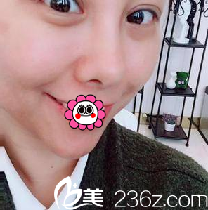 在北京美萊做埋線雙眼皮鼻綜合第8天效果 在北京美萊做埋線雙眼皮鼻綜合第8天效果