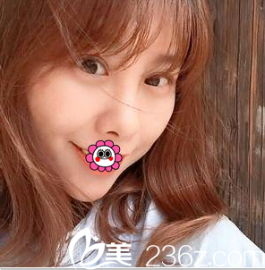 北京美萊埋線雙眼皮鼻綜合案例 北京美萊埋線雙眼皮鼻綜合案例