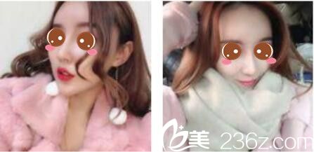 韓國(guó)尹熙根整形外科尹熙根假體隆鼻真人案例術(shù)后一個(gè)月