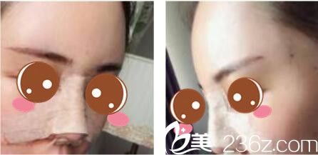 韓國(guó)尹熙根整形外科尹熙根假體隆鼻真人案例術(shù)后第三天