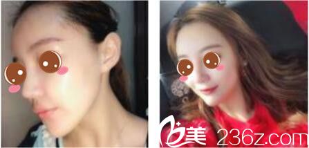 韓國(guó)尹熙根整形外科尹熙根假體隆鼻真人案例術(shù)后兩個(gè)月