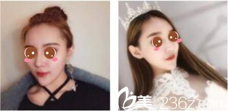 韓國(guó)尹熙根整形外科隆鼻技術(shù)好不好？曬曬尹熙根為我做假體隆鼻術(shù)后三個(gè)月效果圖