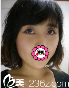 在北京美萊玻尿酸豐臥蠶注射瘦臉前樣子 在北京美萊玻尿酸豐臥蠶注射瘦臉前樣子